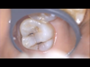 コンポジットレジン治療　～左上第一・第二大臼歯～