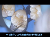麻酔抜髄②　～虫歯の除去、歯髄（神経）の露出～